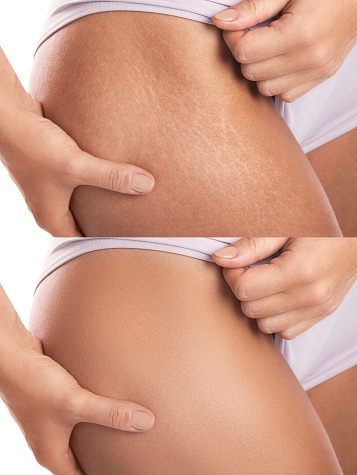 Aloe Vera Reduces Stretch Marks