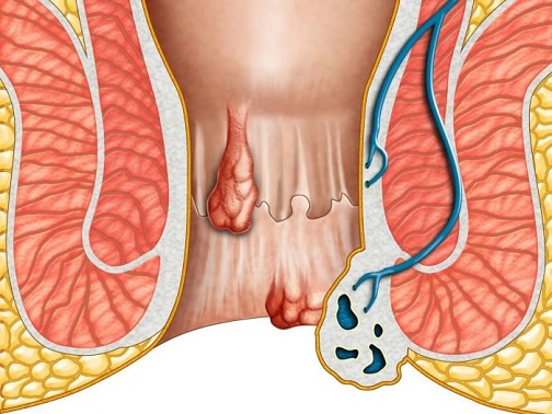 Aloe Vera Helps in Treating Hemorrhoids