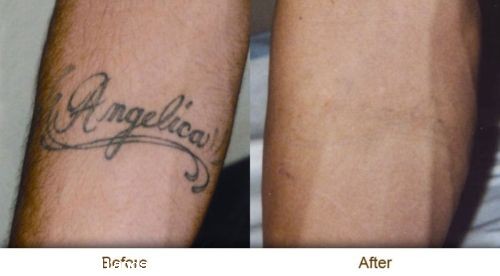Almost Complete Laser Tattoo Removal