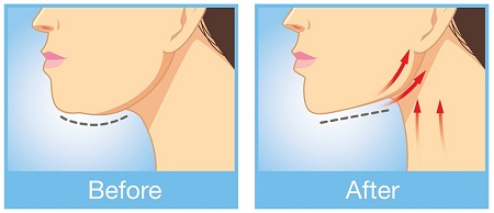 Reduce Double Chin Fast At Home