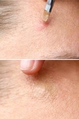 How to Conceal Pimples