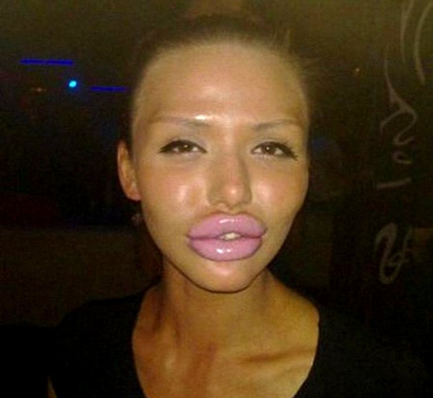 Should I Get Lip Fillers?