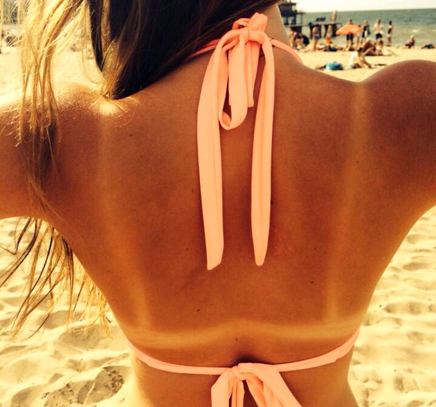 Sunburn Relief Hacks That Work!
