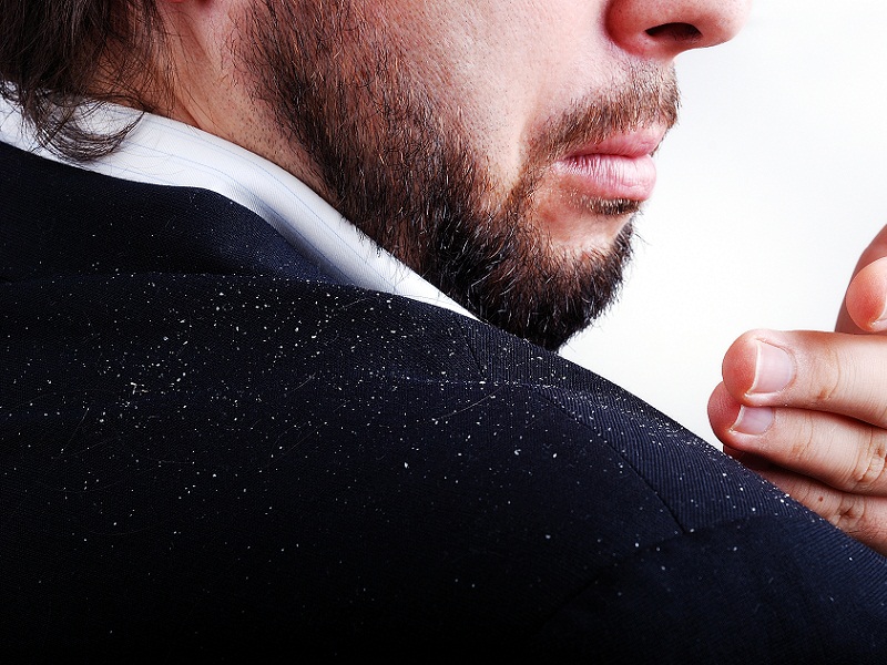 10 Main Causes Of Dandruff On Your Scalp! | I Fashion Styles