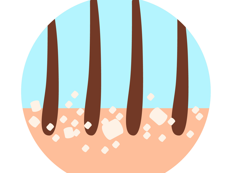 10 Main Causes Of Dandruff On Your Scalp! | I Fashion Styles