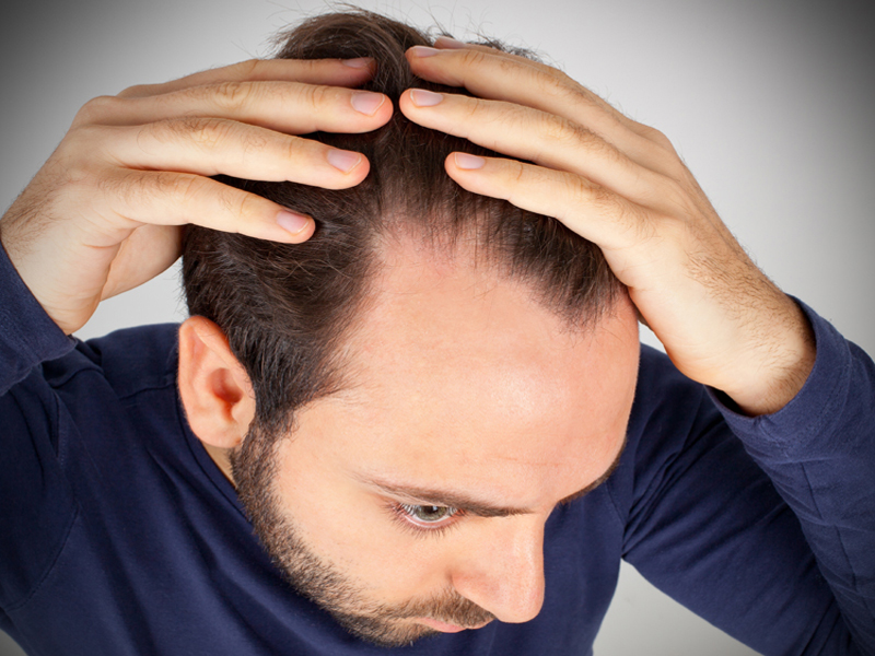 Hair Loss Due to Hormonal Imbalance - How to treat?