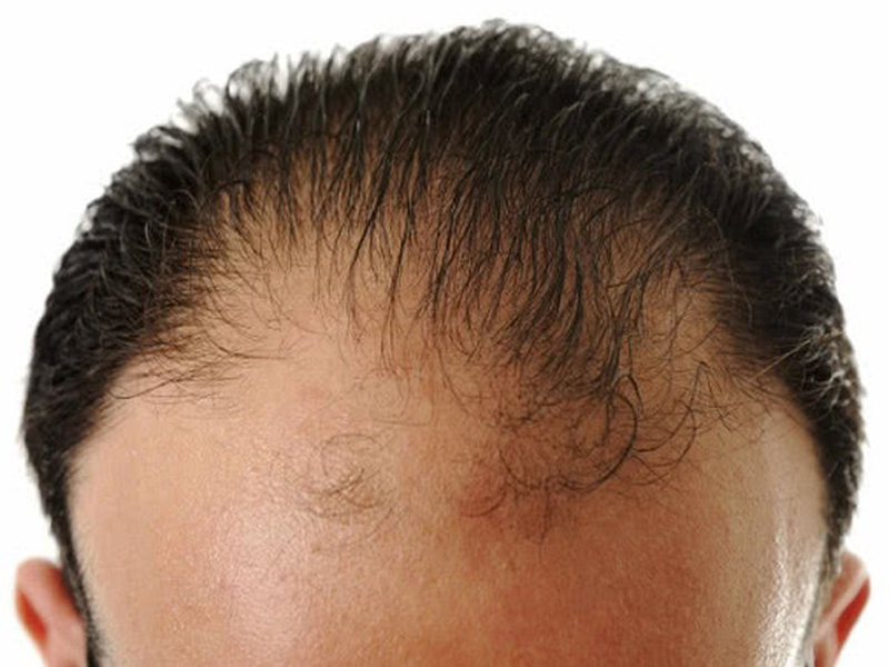 Front Hair Loss - How to Treat? | I Fashion Styles