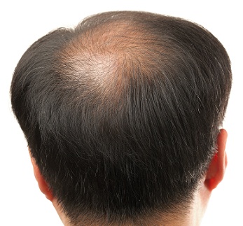 Dr Batra's Hair Loss Treatment | I Fashion Styles