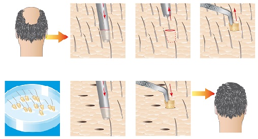 Top 9 Hair Transplant Centers In Chennai | I Fashion Styles