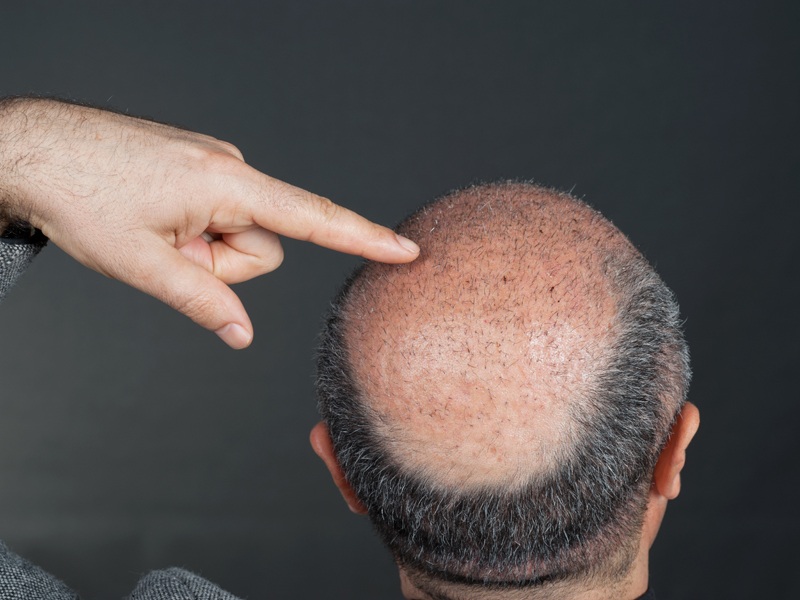15 Best Clinics For Hair Transplant In Mumbai | I Fashion Styles