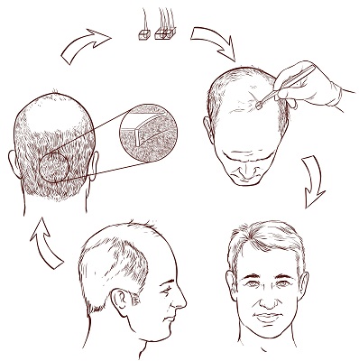 15 Best Clinics For Hair Transplant In Mumbai | I Fashion Styles
