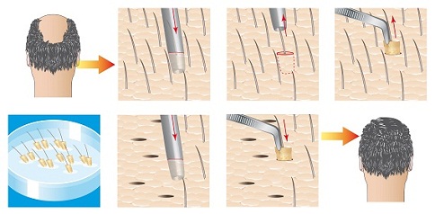 15 Best Clinics For Hair Transplant In Mumbai | I Fashion Styles