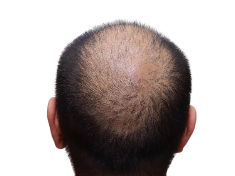 Top 10 Hair Transplant Centers In Bangalore | I Fashion Styles