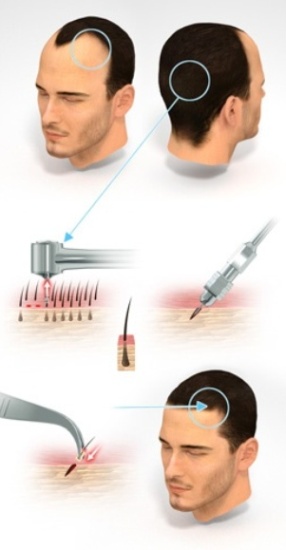 9 Best Hair Transplant Centers In Kolkata | I Fashion Styles