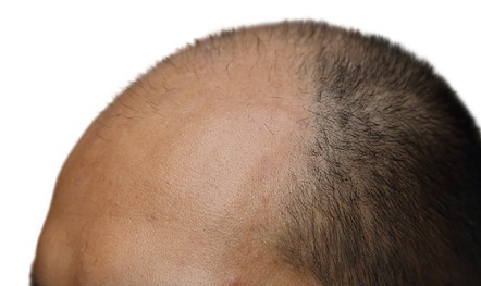 9 Best Hair Transplant Centers In Jaipur | I Fashion Styles