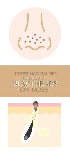 25 Amazing Home Remedies For Blackheads |I Fashion Styles
