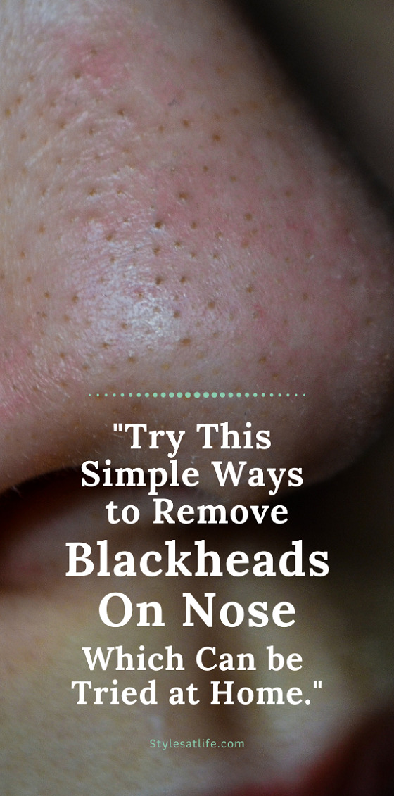 Nose Blackheads: 15 Best Ways to Remove Black Clogged Pores on Nose