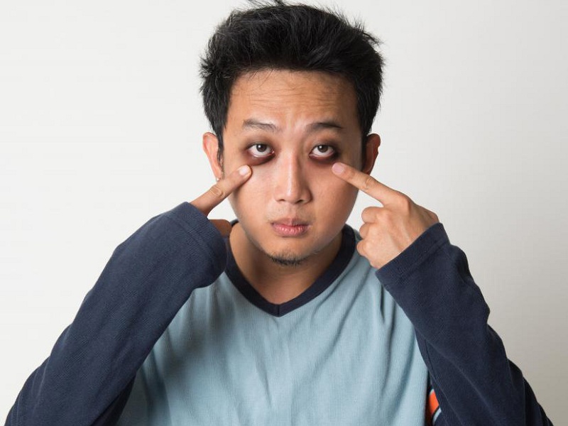 How To Get Rid Of Men&#039;s Dark Circles Under Eyes? | I Fashion Styles