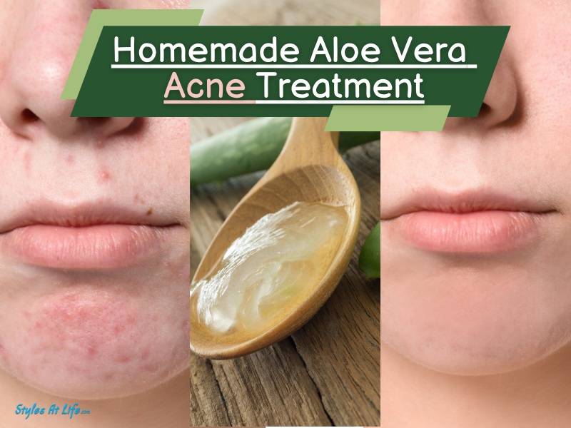 Homemade DIY Aloe Vera Acne Treatment (6 Simple Ways)