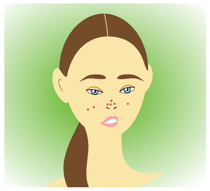 Homemade DIY Aloe Vera Acne Treatment (6 Simple Ways)