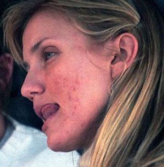 10 Famous Actresses Caught with Pimples On-Camera