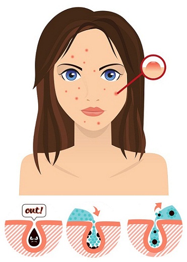 30 Natural Tips to Cure Pimples Completely from Face