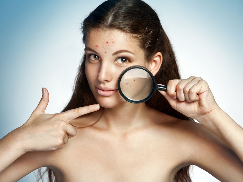 Ayurvedic Treatments For Pimples (Acne) - 10 Ingredients That Work!