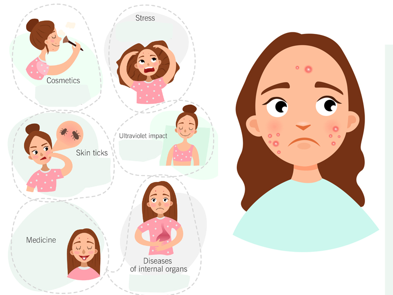 9 Main Causes Of Pimples (Acne) You Should Know | I Fashion Styles