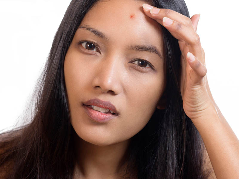 Pimples on Forehead - Causes, Home Remedies &amp; Medical Treatments!