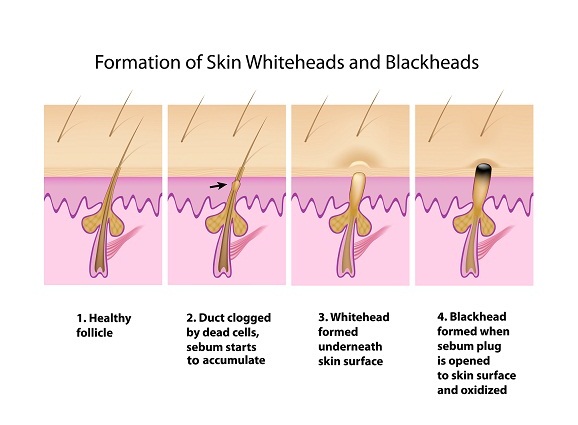 Different Types Of Pimples - How to Cure | I Fashion Styles