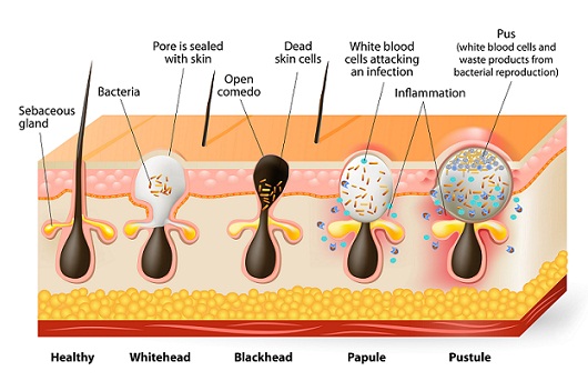 Different Types Of Pimples - How to Cure | I Fashion Styles