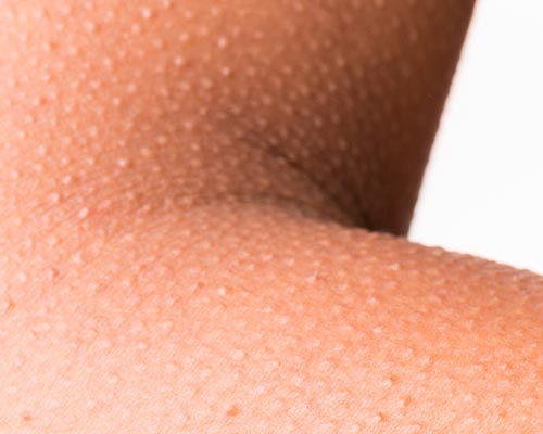 Goose Pimples – How To Treat? | I Fashion Styles