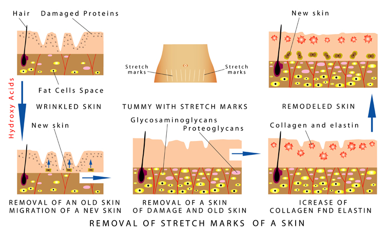 Stretch Marks: 8 Best Home Remedies for Striae (Albae &amp; Rubrae)