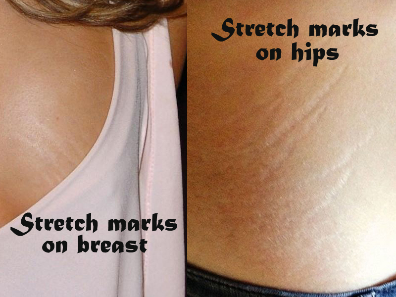 Stretch Marks: 8 Best Home Remedies for Striae (Albae &amp; Rubrae)