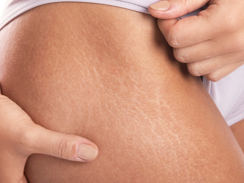 Stretch Marks: 8 Best Home Remedies for Striae (Albae &amp; Rubrae)