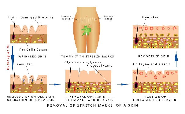 How to Get Rid of Stretch Marks Fast and Naturally? | I Fashion Styles
