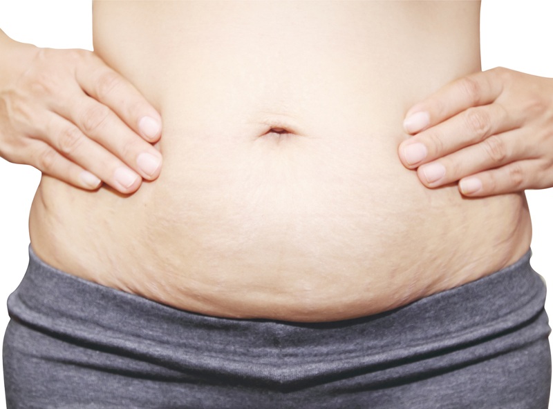 Striae Gravidarum: When to Expect and How to Avoid it?