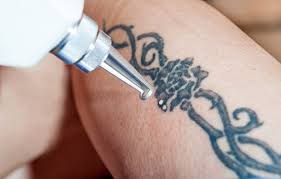 Different Ways To Remove Permanent Tattoo Easily? | I Fashion Styles
