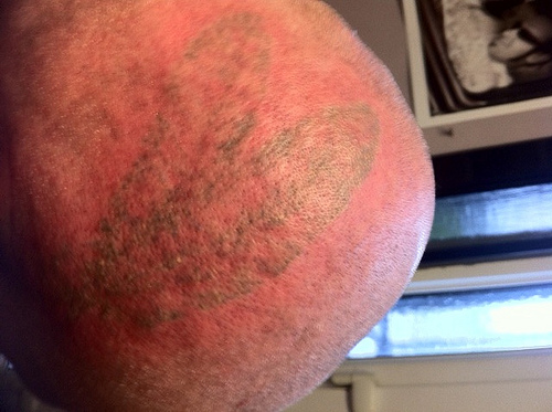 9 Best Laser Tattoo Removal Treatments | I Fashion Styles