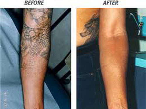 9 Best Laser Tattoo Removal Treatments | I Fashion Styles