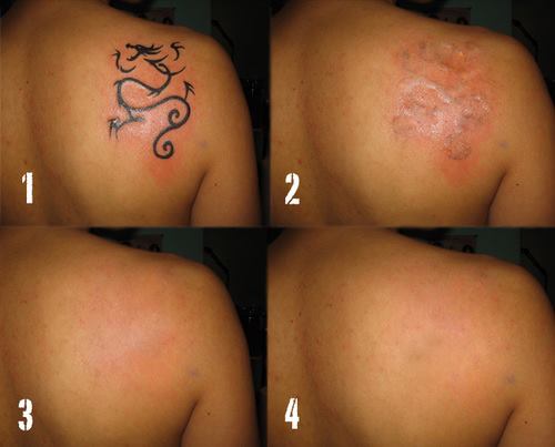 9 Best Laser Tattoo Removal Treatments | I Fashion Styles