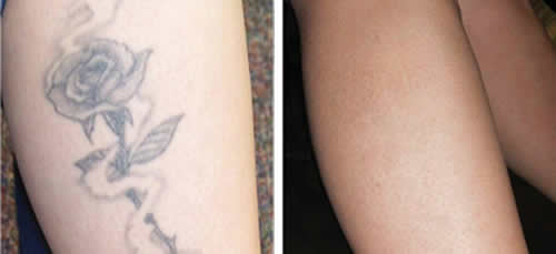 9 Best Laser Tattoo Removal Treatments | I Fashion Styles