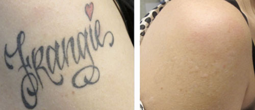 9 Best Laser Tattoo Removal Treatments | I Fashion Styles