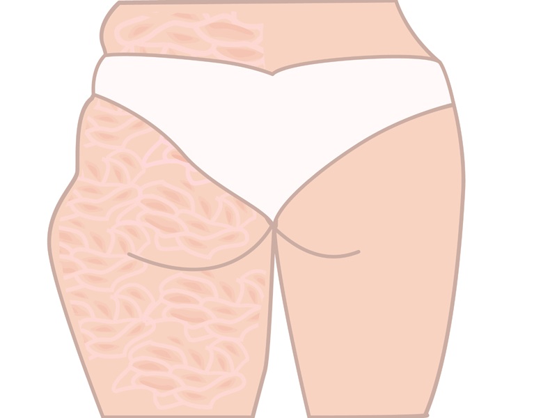 9 Simple Exercises To Get Rid of Cellulite On Buttocks
