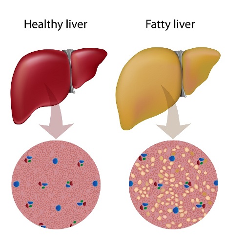 9 Natural and Best Home Remedies For Fatty Liver Disease