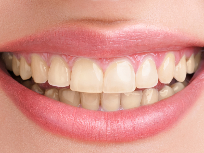 Yellow Teeth: 20 Best Home Remedies for Teeth Discoloration