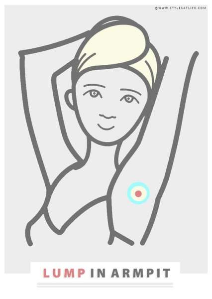 Painful Lump in Armpit - Causes, Symptoms &amp; Natural Treatments