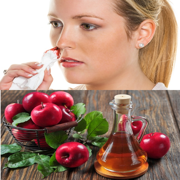 9 Home Remedies for Nose Bleeding: Causes &amp; Symptoms | I Fashion Styles