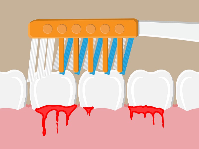 15 Best Natural Ways to Stop the Bleeding from Gums