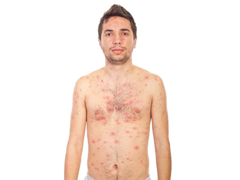 21 Simple And Effective Home Remedies To Get Rid Of Chickenpox